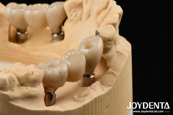comprar Implantes de zirconia perfectos con dientes naturales cero riesgo de alergia fabricación en línea