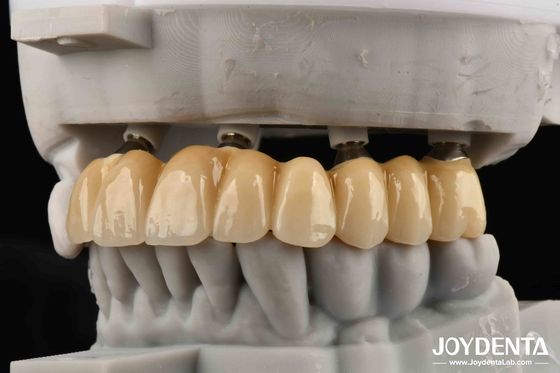 comprar Amigos Cercanos de la Fundación Bones Of Beauty Implantes de Zirconia, una Elección Estéticamente Superior sin Riesgo de Alergia al Metal fabricación en línea