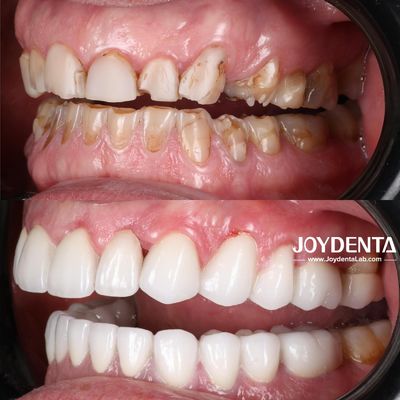 comprar Dentaduras de zirconia que imitan los dientes naturales fabricación en línea