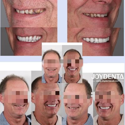 comprar Dentaduras de zirconia que imitan los dientes naturales fabricación en línea