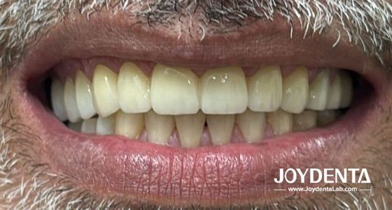 comprar Dentaduras de zirconia que imitan los dientes naturales fabricación en línea