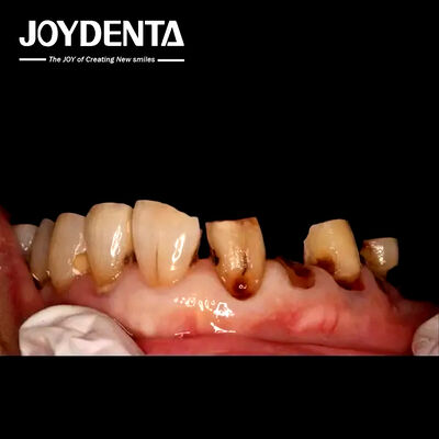 comprar Coronas de Zirconia Premium para los laboratorios dentales globales. fabricación en línea