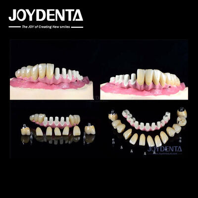 comprar Múltiples implantes dentales endosseo conexión interna para la restauración de arco completo fabricación en línea