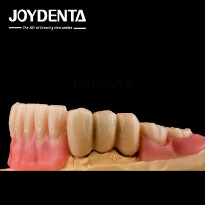 comprar Prótesis de acero inoxidable Dentes postizas parciales Adjuntos de bolas de superficie pulida Adjuntos fabricación en línea