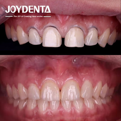 comprar Laboratorio de Carillas Dentales de Odontología Estética | Outsourcing de Carillas Premium de Porcelana y Composite - Joydentalab fabricación en línea