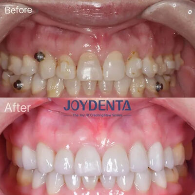 comprar Carillas dentales para dientes perdidos | Servicios de laboratorio dental premium globales fabricación en línea