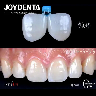 comprar Indicación de los dientes anteriores carillas dentales sin necesidad de preparación y sin decoloración fabricación en línea