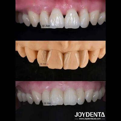 comprar Las carillas de la langosta La solución perfecta para las carillas dentales translúcidas naturales fabricación en línea