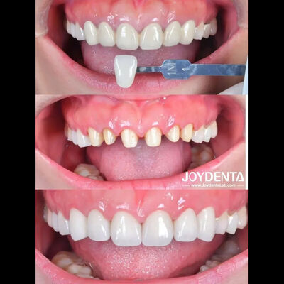 comprar Estudio de caso de la corona dental de zirconia. fabricación en línea
