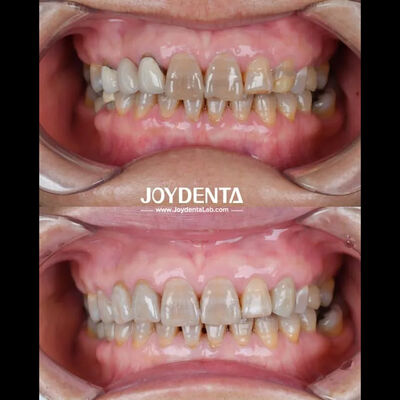 comprar Circonia dental ligera para una experiencia óptima del paciente Transiciones de color naturales y biocompatibilidad garantizada fabricación en línea