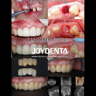 comprar Tecnología de gradiente multicapa Zirconia dental segura y estéticamente agradable a largo plazo fabricación en línea