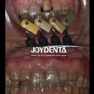 comprar Coronas de zirconia translúcidas Tecnología de gradiente multicapa fabricación en línea