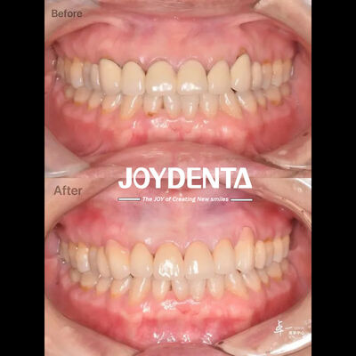 comprar Circonia dental de alta resistencia a las fracturas para tejidos orales seguros y compatibilidad CAD / CAM fabricación en línea