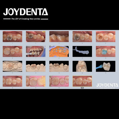 comprar Adultos Niños Incremento dental de cerámica de porcelana Restaurador para dientes dañados fabricación en línea