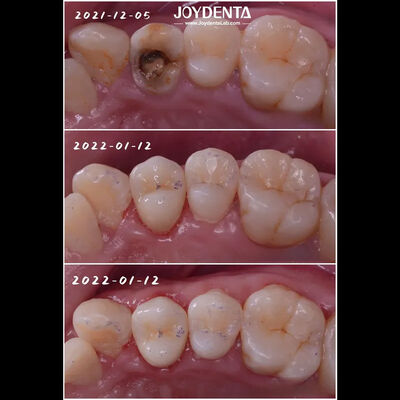 comprar Inserción de porcelana dental de ajuste exacto Restauración de dientes dañados fabricación en línea
