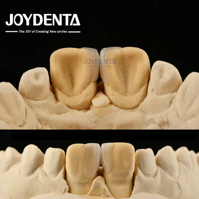 comprar 0.2 mm de espesor Carillas de microtino Carillas dentales cerámicas de vidrio para dientes delanteros fabricación en línea