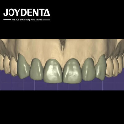 comprar Impresión en 3D Virtual Digital Wax Up Compatibilidad perfecta con otros programas dentales fabricación en línea