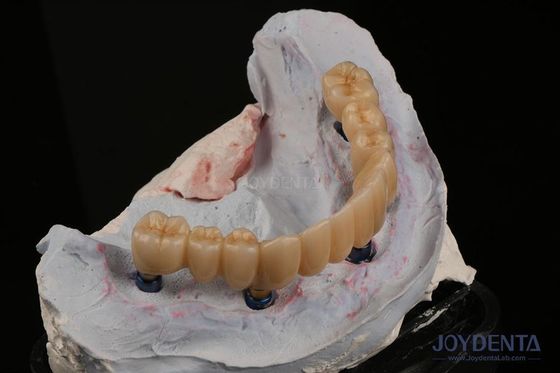 Restauración dental Implante dental múltiple Endosseo Reemplazo de dos dientes delanteros