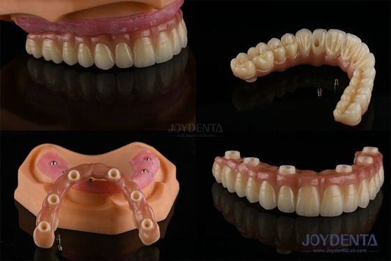 Dentistas Remplazo de dientes múltiples Implantes de superficie áspera Componentes protésicos