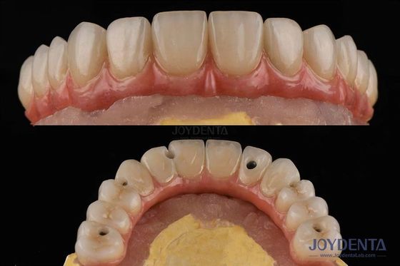 Plataforma de implantes dentales de superficie áspera Puentes dentales con conexión interna