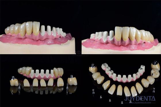 Múltiples implantes dentales endosseo conexión interna para la restauración de arco completo