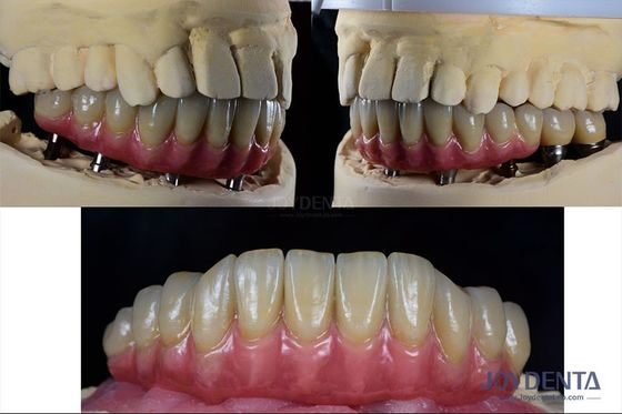 Reconstrucción dental Implante dental múltiple Titanio Conexión protética interna
