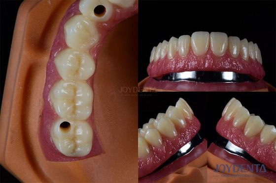 Implantes dentales múltiples de titanio Dentes Implantes internos resistentes a las grietas personalizados