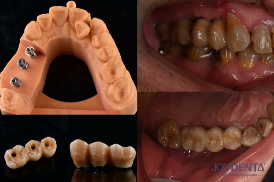 Estabilidad de color ultra dura Implante dental Corona OEM fácil de mantener duradero