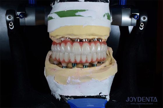 Implante de diente simple de 10 mm de longitud con radiación gamma para obtener resultados quirúrgicos óptimos