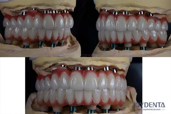 Implante dental múltiple de titanio de 10 mm Superficie áspera para la restauración dental