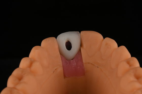 Implantes dentales de titanio de superficie rugosa Cirugía para reemplazo de dientes frontales