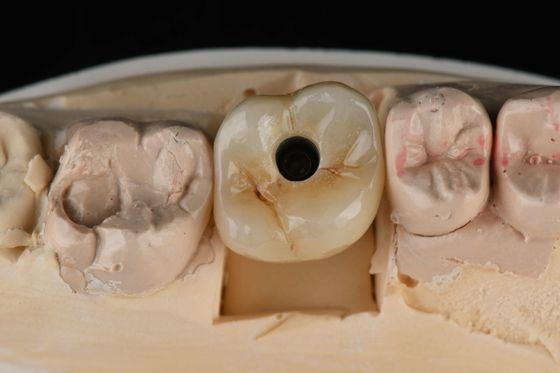 Implantes dentales de titanio de 10 mm con un solo diente Reemplazo de abutment auto-tapping