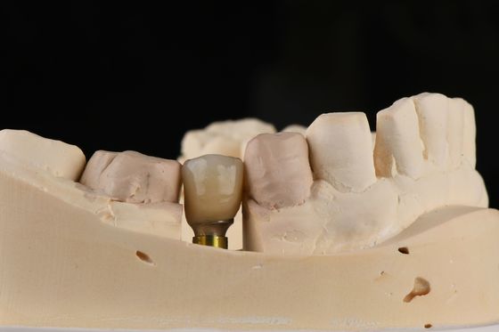Implante de diente único con herramienta de presión y conexión hexagonal interna
