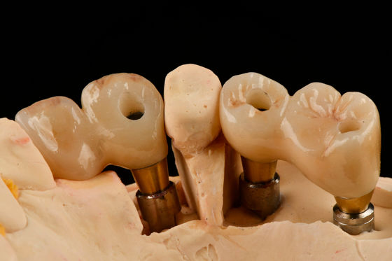 Implante dental de titanio de hilos de 3,0 mm de auto-toque Funcionalidad optimizada