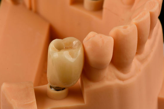 Conexión hexadecimal interna Implantes dentales de titanio ensartados reemplazo de dientes simples
