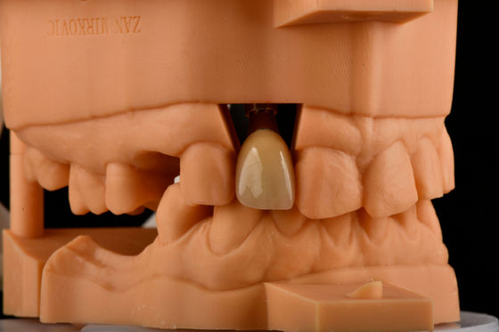 Hex interno de 3,0 mm de profundidad de 1,5 mm de tono de reemplazo de implante dental de titanio único