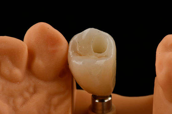 Implantes dentales de titanio con un solo diente Tipo de conexión hexadecimal interna para un ajuste óptimo