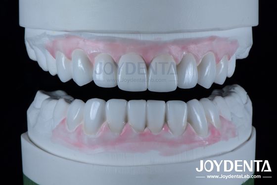 Restauraciones dentales de alta precisión de cera en odontología 1-2 mm de espesor