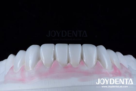 Cera de diagnóstico digital personalizada para la replicación de la anatomía dental natural