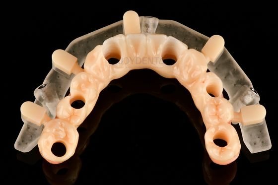 Plantillas de cirugía guiada impresas en 3D de precisión personalizada para la colocación precisa de implantes