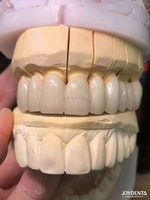 Porcelana de ajuste de precisión fundida a metal PFM Coronas sin costuras Mejora natural de la sonrisa