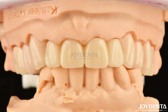 Biocompatible PMMA M75 Restauración Resistente a los arañazos para la estética dental