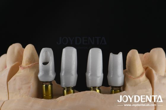 Implantes dentales personalizados de zirconia para restauraciones de unidad única o múltiple
