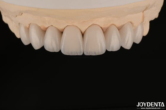 Carillas dentales suaves y ligeras, biocompatibles y cómodas para la salud oral