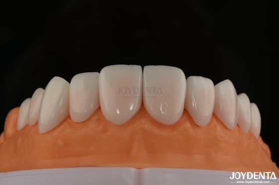 Confort óptimo para el paciente con carillas de porcelana biocompatibles y suaves en los tejidos orales