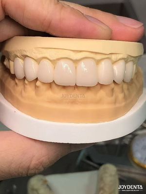Sombras personalizadas para que coincidan con los dientes naturales Biocompatibles y resistentes a las manchas carillas dentales