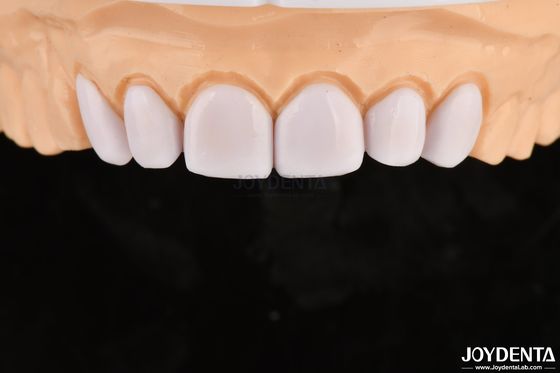 Carillas dentales para dientes mal alineados Biocompatibilidad y suavidad en los tejidos orales