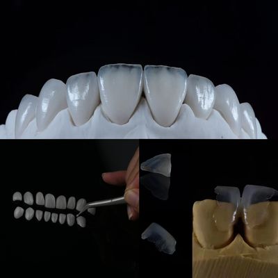 La carilla cerámica de vidrio le dará una sonrisa natural con esta solución dental superior