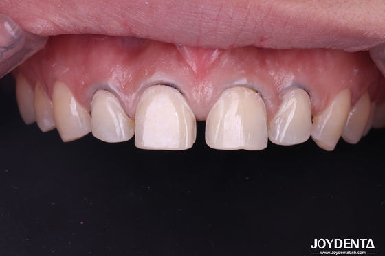 Carillas de porcelana dental de aspecto real perfectamente ajustadas Carillas de cerámica para dientes frontales