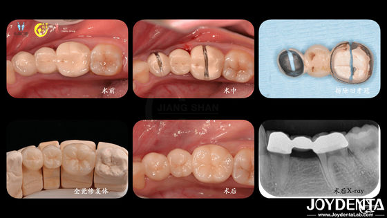 Coronas dentales de zirconia personalizadas Biocompatibilidad Confort Personalización para una experiencia óptima del paciente
